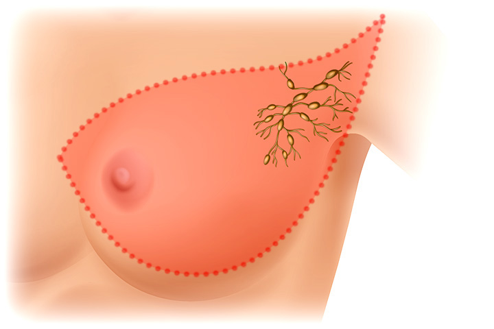 استئصال الثدي والعقد اللمفاوية