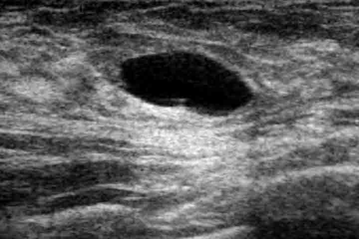 أكياس الثدي