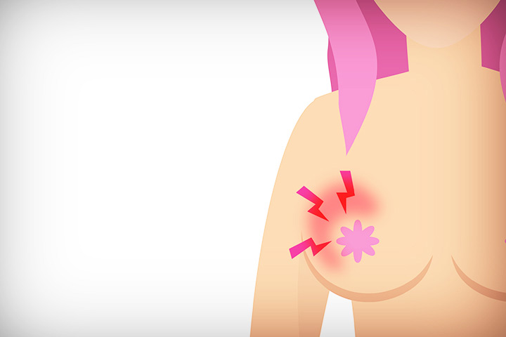 التهاب الثدي الحاد والمزمن