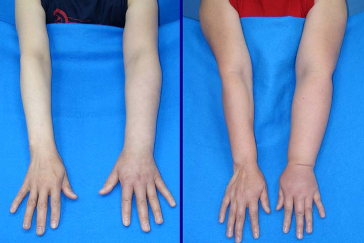 الوذمة اللمفاوية بعد عملية استئصال الثدي