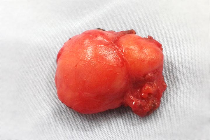 الورم الليفي في الثدي