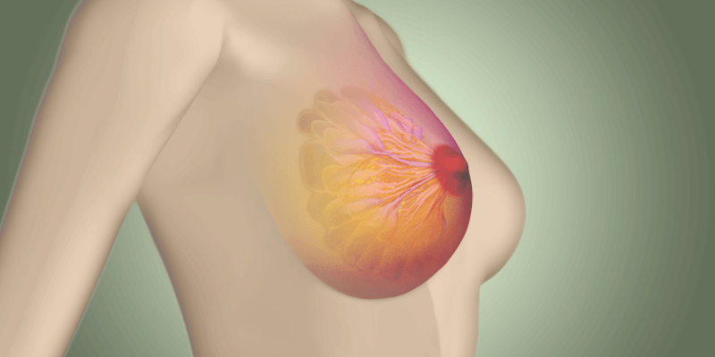 أمراض وعمليات الثدي وجراحتها وسرطان الثدي
