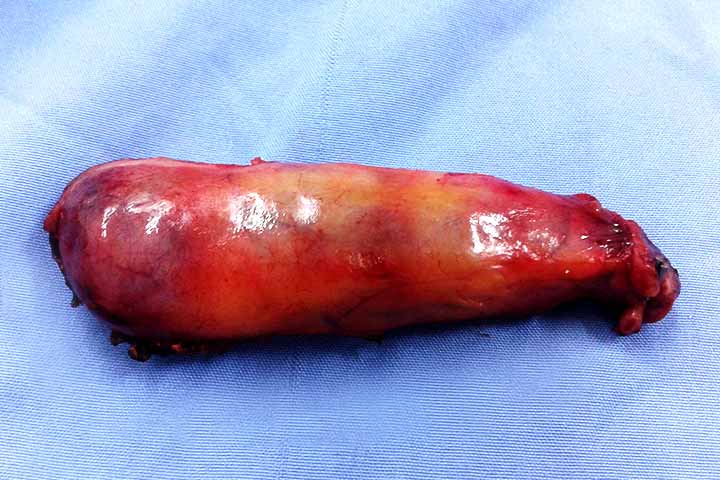 التهاب المرارة الحاد والمزمن وعلاجه