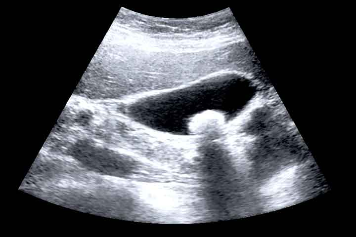 علاج حصى المرارة