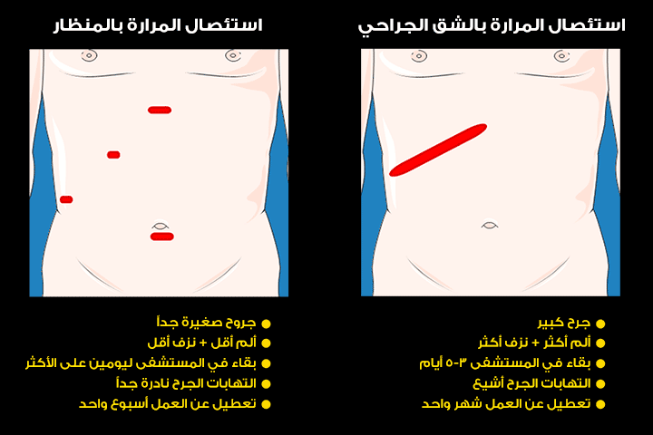 عملية المرارة بالمنظار افضل ام الجراحة