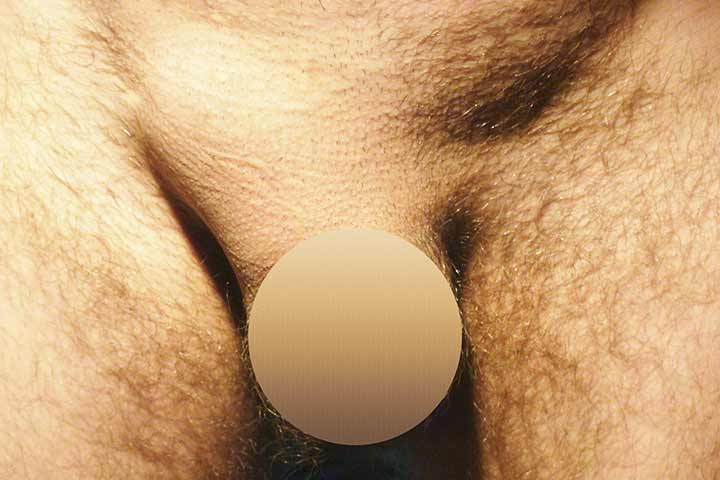 أسباب وأعراض الفتق إربي