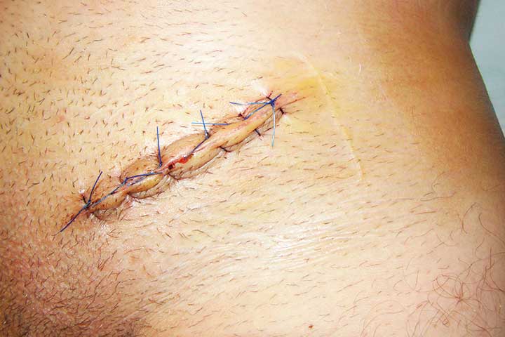 علاج الفتق الإربي