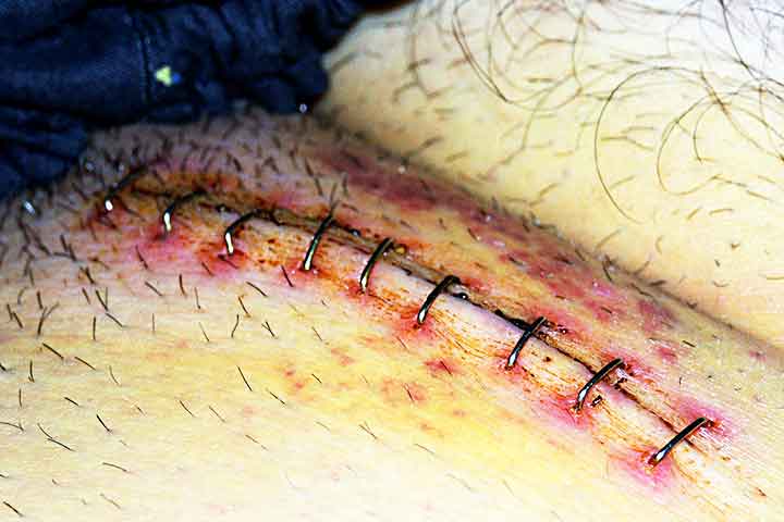 مضاعفات عملية الفتق الاربي مضاعفات عملية الفتق الاربي