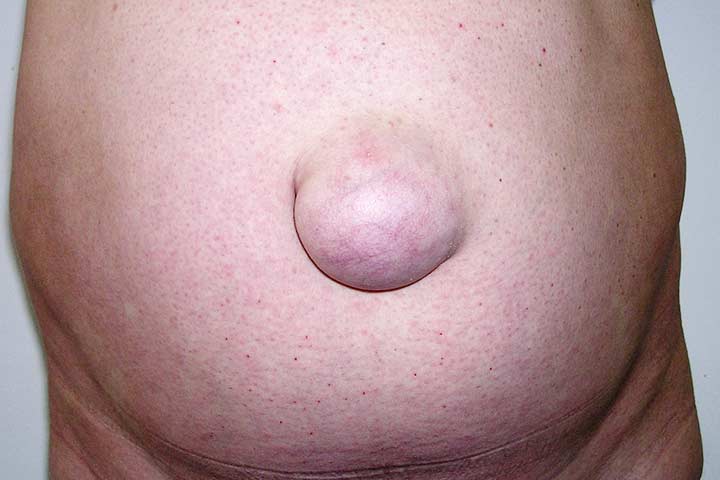 أسباب و أعراض فتق السرة