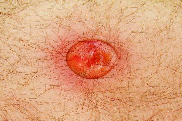 التهاب السرة