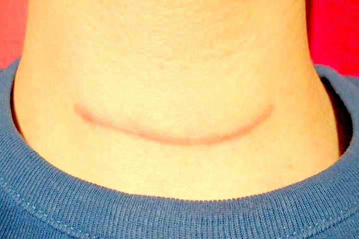 مشاكل الجرح بعد عملية الغدة الدرقية