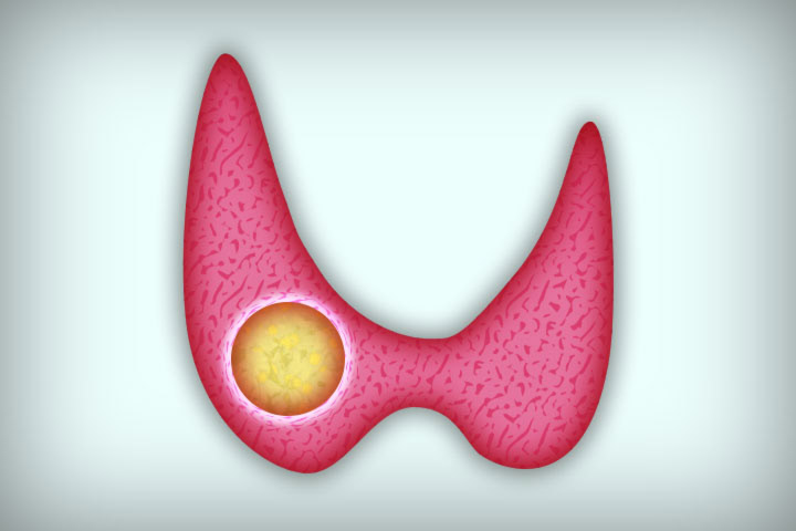 العقدة الدرقية الوحيدة