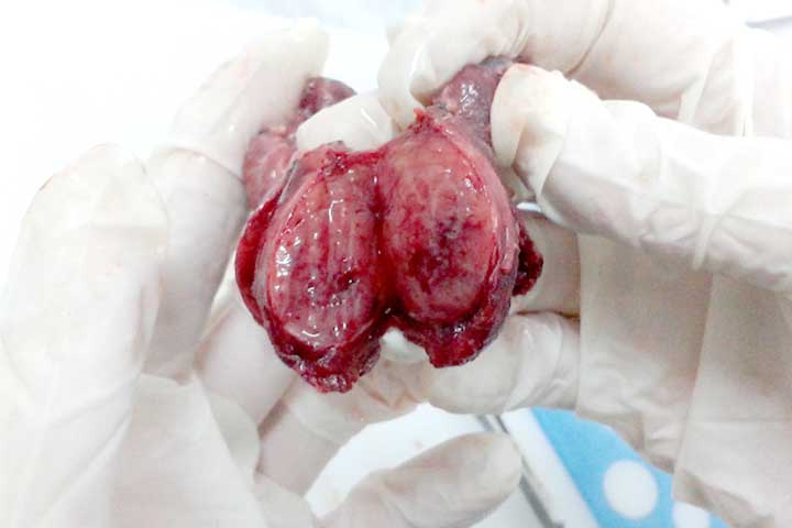 الورم الجريبي في الغدة الدرقية