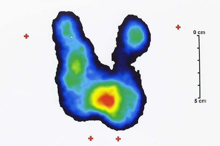 اليود المشع المسح الذري التشخيصي للغدة الدرقية