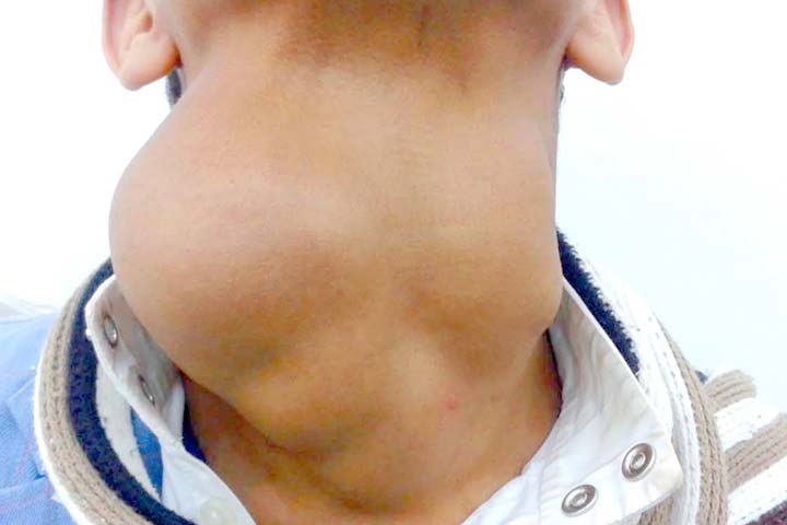 عقد الغدة الدرقية