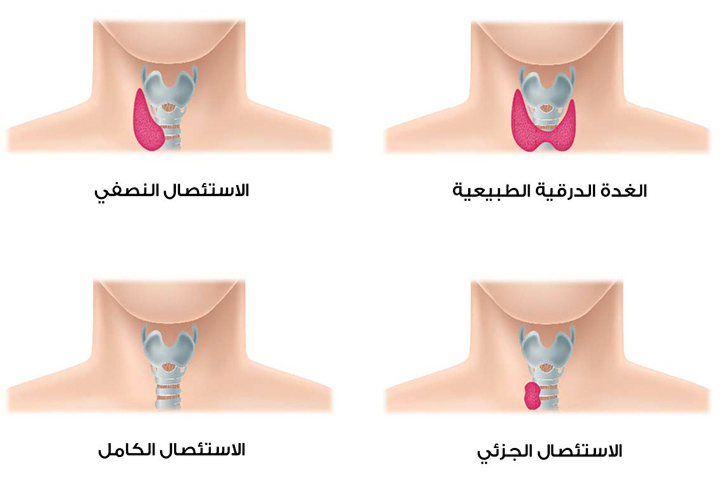 عملية استئصال الغدة الدرقية النصفي الكامل