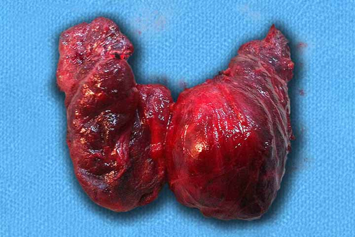 عملية استئصال الغدة الدرقية
