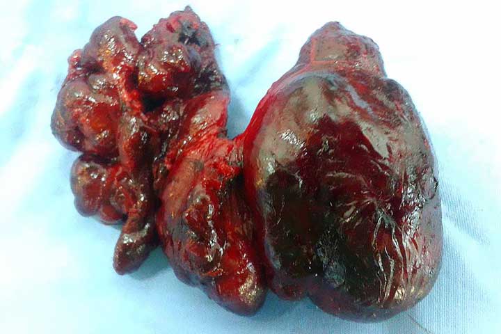 ورم الغدة الدرقية ورم الغدة الدرقية بالصور الحقيقية