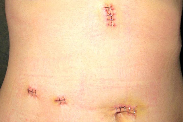 احمرار جرح العملية