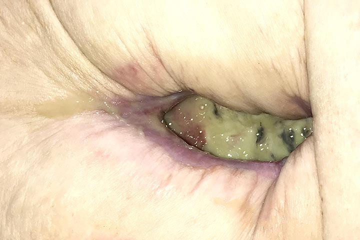 افرازات صفراء صديدية من جرح العملية الجراحية