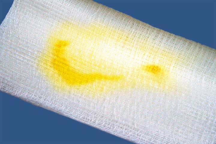 خروج افرازات صفراء من الجرح على الضمادة