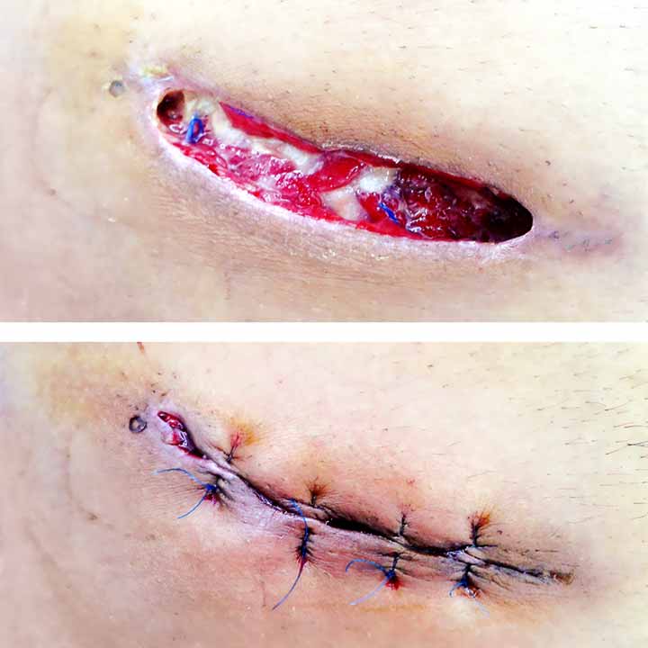 يمكن أحياناً خياطة الجرح بعد شفاء الالتهاب