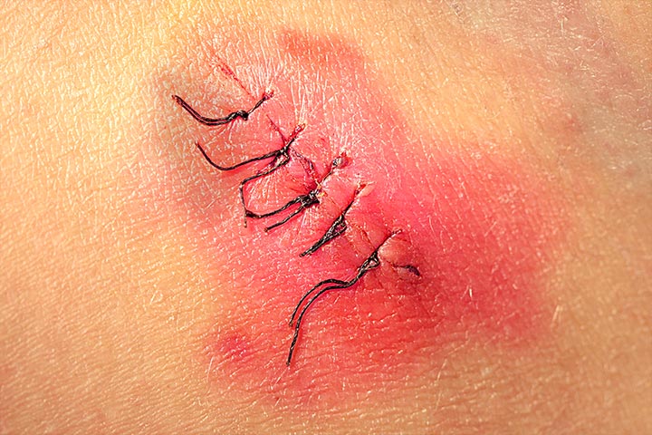 التهاب واحمرار وتورم الجرح بعد العملية الجراحية