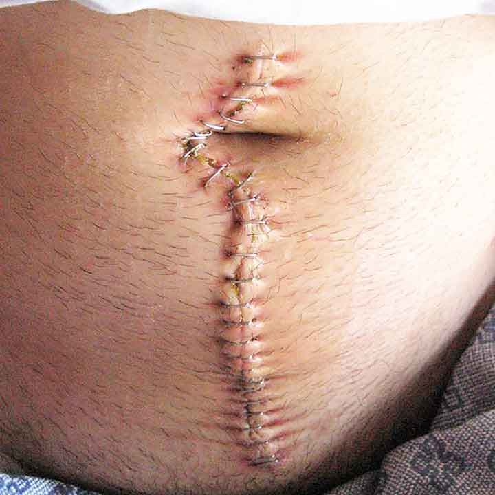 انتفاخ جرح العملية الجراحية