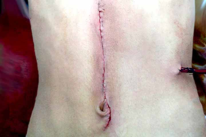 الخياطة الداخلية للجروح بدون خيط خارجي