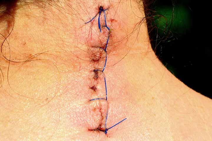 خيوط الجرح بعد العملية الجراحية