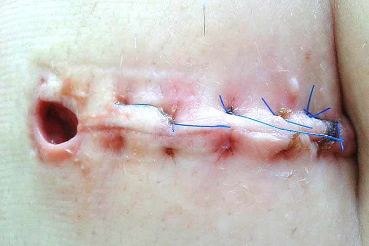 التئام الجروح المفتوحة