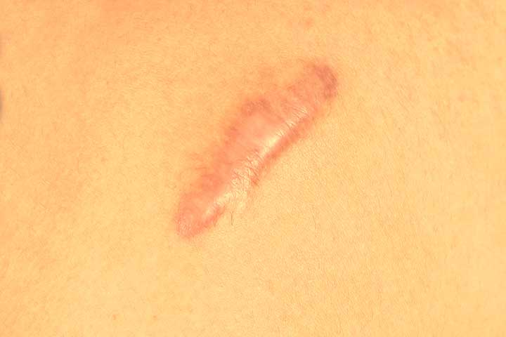 علاج ندبات العمليات الجراحية