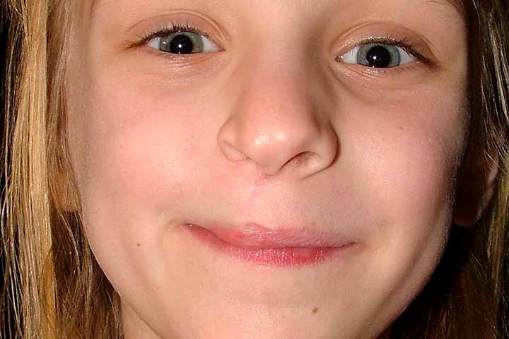 ندبة رفيعة وغير ظاهرة على الوجه