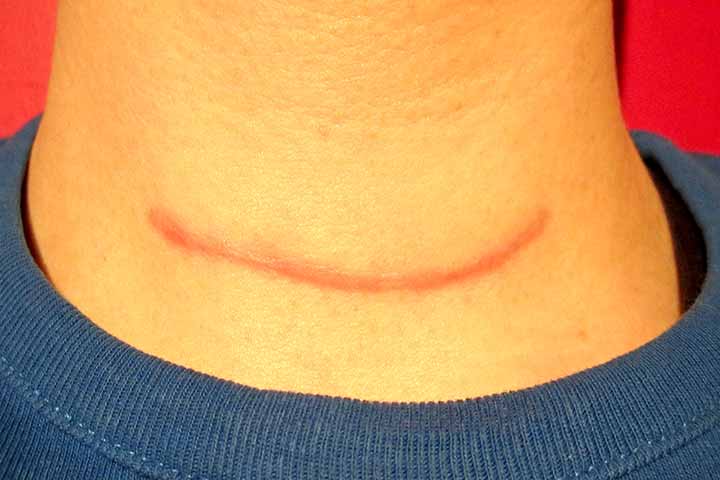 ندبة عملية استئصال الغدة الدرقية على الرقبة