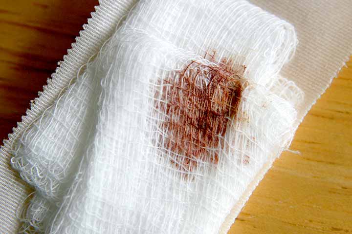 خروج كمية بسيطة من الدم بعد العملية الجراحية